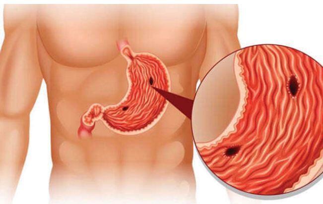 के तपाइलाइ ग्यास्ट्रीक  त भएको त छैन? हासियार रहनुहोस अल्सर हुँदै क्यानसर पनि हुन सक्छ